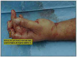 Innervated Cross Finger Flap for Fingertip Reconstruction: An Old Classic Revisited