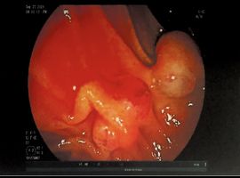 Intraductal Papillary Mucinous Neoplasm Disguised as Pyrosis and Hyperglycemia: A Case Report
