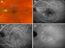 Retinal Angiography Demonstrating Choroidal Fibrosis in Central Serous Chorioretinopathy