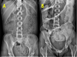 Neostigmine-Induced Reversal of Faecal Impaction and Severe Constipation in a Young Patient with Systemic Sclerosis