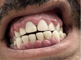 Gingival Overgrowth in Acute Myeloid Leukemia