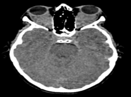 Pediatric Idiopathic Orbital Pseudotumour: A Diagnostic Challenge in Radiologic Imaging