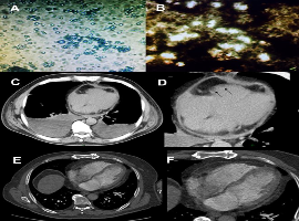 Isolated Cardiac Cryptococcosis in an Immunocompetent Host