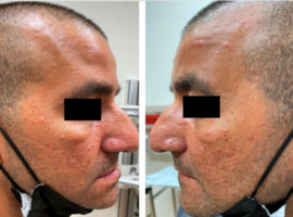 Managing Cyclosporine-Induced Sebaceous Hyperplasia in a Renal Transplant Patient: Efficacy of Oral Isotretinoin