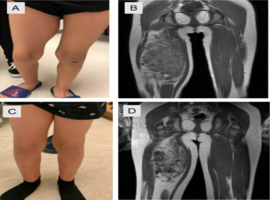 Fibro-adipose Vascular Anomaly