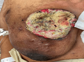 Unusual Presentation of Malignant Breast Tumor