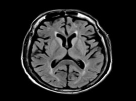 A Challenging Case of Beta-lactam Induced Encephalopathy: A Case Report