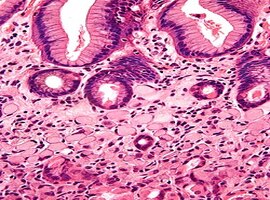 Signet Ring Cell Carcinoma Presenting as Terminal Ileitis: A Case Report