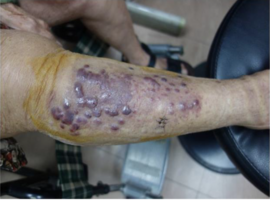 Stewart-Traves Syndrome