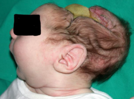 Neonatal Meningitis: A Disastrous Outcome of Klebsiella Pneumoniae Infection