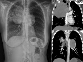 Treatment Resistance of Lung Metastases from Adrenal Carcinoma