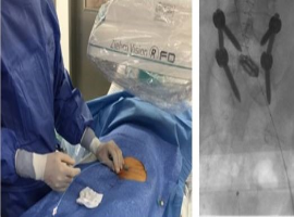 Endovascular Management of Iliac Vein Compression Syndrome Due to Pedicle Screw Malposition After Posterior Lumbar Fusion Surgery