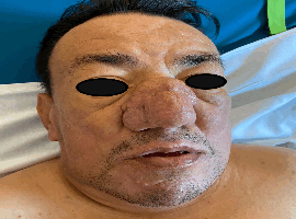 Rinophyma in ASMD Niemann-Pick Disease Type B