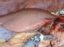 Falciform Ligament Necrosis: A Rare Clinical Entity