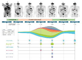 Crizotinib Re-Challenge Overcomes Multiple Resistant Clones in cMET Positive NSCLC Patient