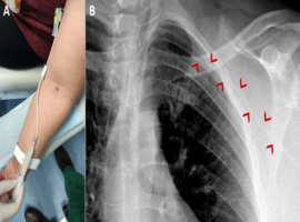 Totally Implanted Venous Catheter: What Can Go Wrong