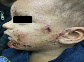 Skin Pruritus from Atopic Dermatitis Revealing Thrombopathy