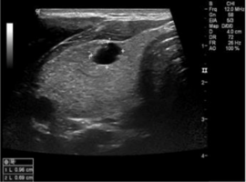An Ectopic Intrathyroidal Parathyroid Adenoma in a Minimally Symptomatic Hypercalcemic Patient: A Rare Case Presentation