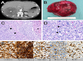 Primary Localized Giant Adrenal Cortical Carcinoma in a Young Adult Woman
