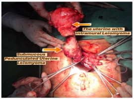 Submucous Pedunculated Uterine Leiomyoma