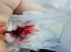 Waugh Syndrome in a One-Month Old Patient