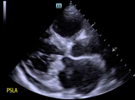 Mitral Valve Vegetation on Bedside Ultrasound Prompts Early Management of Endocarditis with Multiorgan Embolic Disease