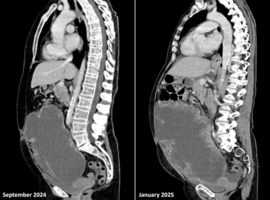 Treatment Resistance in Gastrointestinal Stromal Tumor