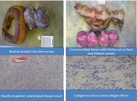An Extra-Pleural Solitary Fibrous Tumour