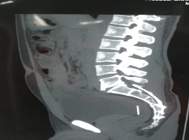 Unusual Noningested Intraperitoneal Needle as a Foreign Body: Laparoscopic Removal with Two Accesses
