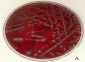 First Case Isolated of Kerstersia gyiorum from Purulent Ear Discharge in North Africa: Case Report