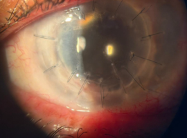 Anterior Segment Collapse in Post-Traumatic Endophthalmitis