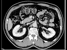 Aggressive Renal Angiomyolipoma with Renal Vein Thrombosis: A Rare Complication