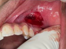 Aberrant Maxillary and Mandibular Buccal Frenum Causing Hypersensitivity in Adolescent and its Management: A Rare Case Report