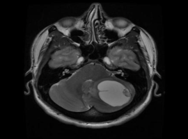 Secondary Erythrocytosis as Presenting Feature of Central Nervous System Hemangioblastoma: A Case Report and Review of Literature
