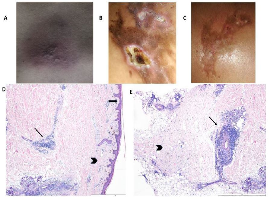 Deep Morphea in the Lower Lumbar Region with Systemic Involvement