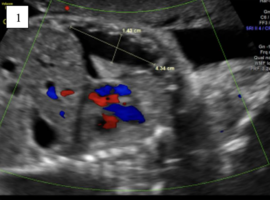 Isolated Fetal Pleural Effusion with Progression to Non-Immune Hydrops Fetalis: A Case Report and Literature Review