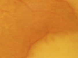 Importance of an Ophthalmic Finding: Hollenhorst Plaques