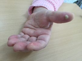 Atypical Location of Tophaceous Gout