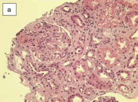 A Rare Case of STEC-HUS Transitioned to Atypical HUS in a Renal Transplant Patient