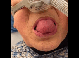 Frog Sign: Uncovered Condition of Long-term Non-invasive Positive Pressure Ventilation in Late-onset Pompe Disease