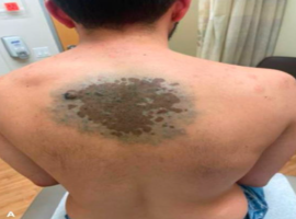 Diagnostic Dilemma: Evolving Nodules in a Giant Congenital Melanocytic Nevus