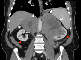 Diffuse Large B-Cell Lymphoma Presenting with Large Adrenal Masses