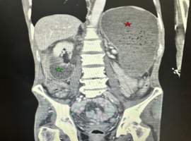 The Rare and Classical Superior Mesentric Artery Syndrome