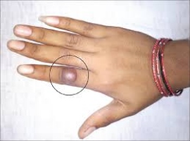 Adenocarcinoma of the Finger: A Case for Sentinel Lymph Node Biopsy