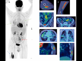 Incidental Finding of Muscle Lymphoma in an Adult with Common Variable Immune Deficiency