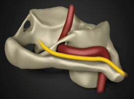 The Overlooked Significance of the Ponticulus Posticus in Whiplash Patients