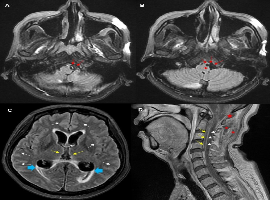 Fatal Central Nerve System Infection After Acupuncture Through the Extra-Axial Space of the Cervicomedullary Junction